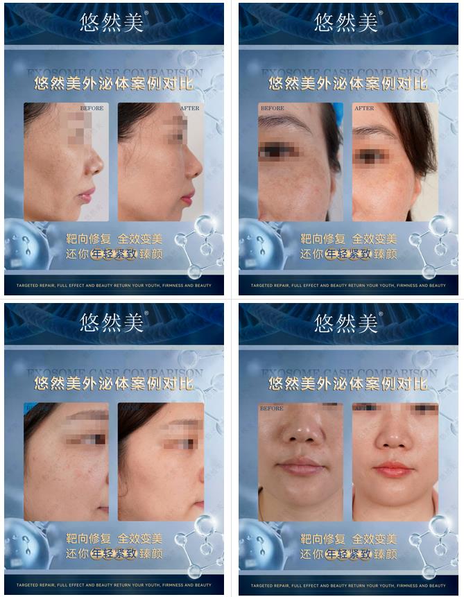 使用悠然美外泌體真實反饋1