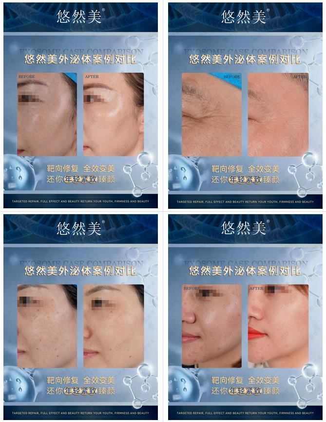 使用悠然美外泌體真實反饋2