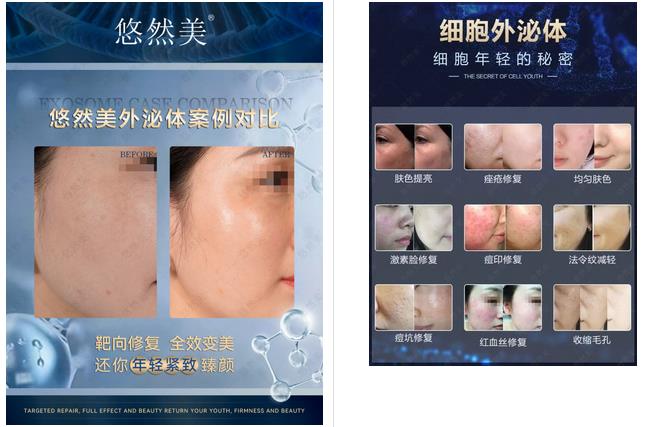使用悠然美外泌體真實反饋3