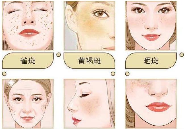 美容院祛斑真的能去掉嗎?會反彈嗎？
